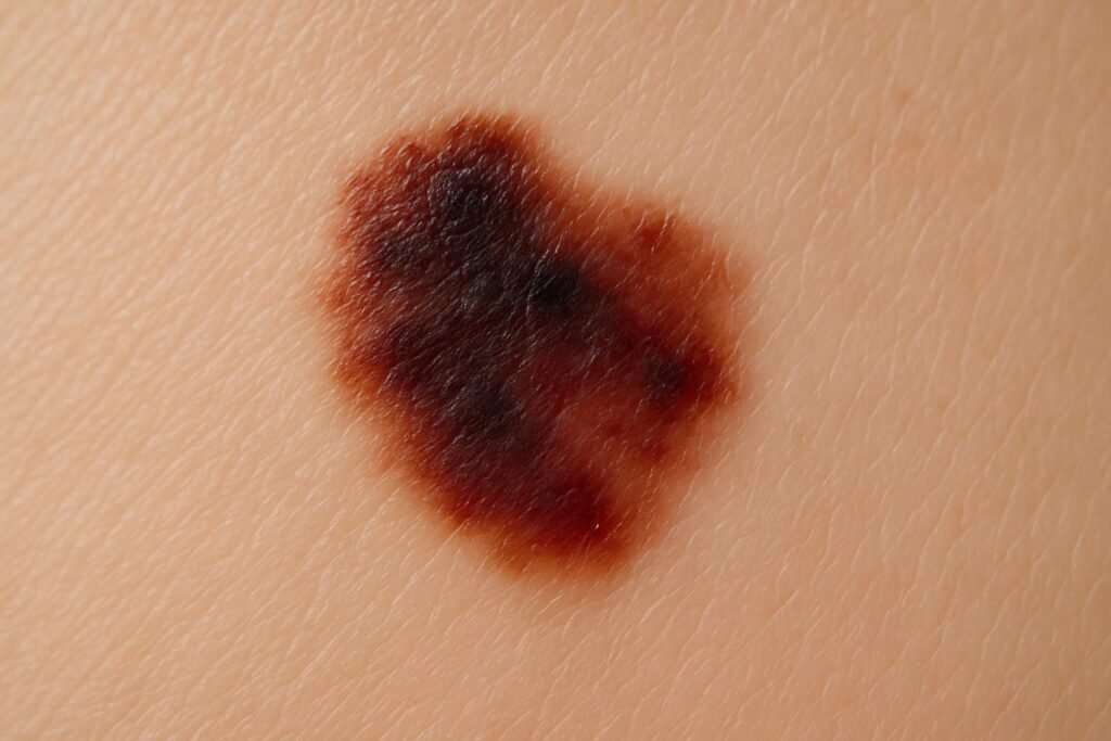 découvrez les signes à surveiller lorsqu'un grain de beauté change, pour détecter rapidement tout risque et protéger votre peau efficacement.