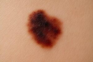 découvrez les signes à surveiller lorsqu'un grain de beauté change, pour détecter rapidement tout risque et protéger votre peau efficacement.